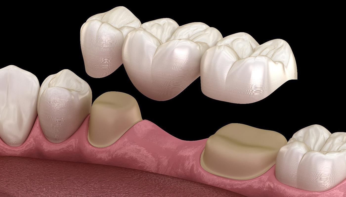 Dental Bridges