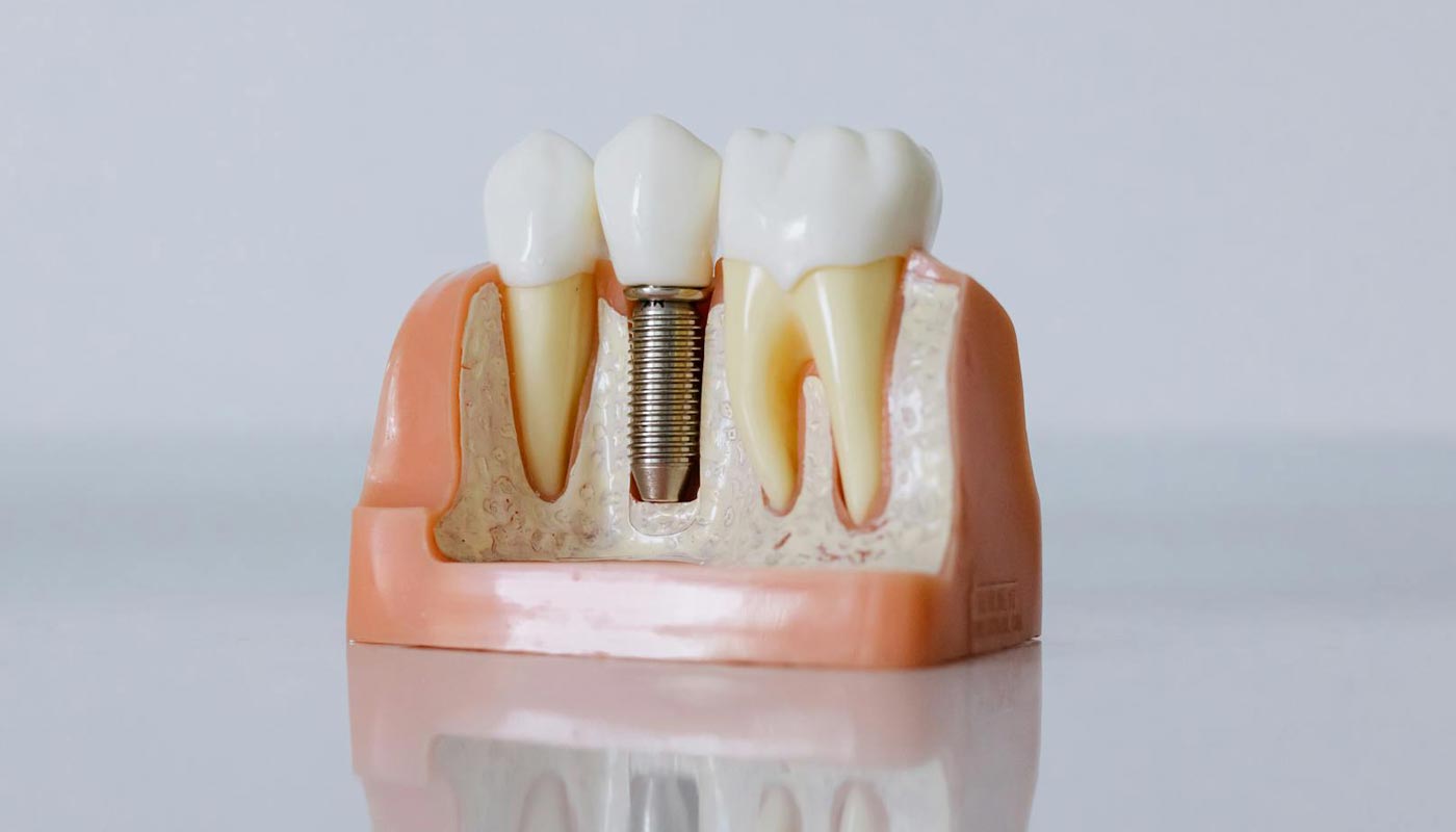 Dental Implant Placement and Restoration