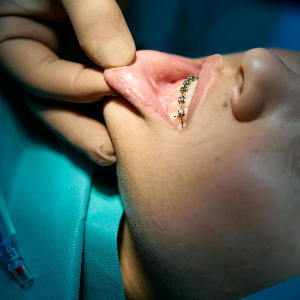 Traditional Braces