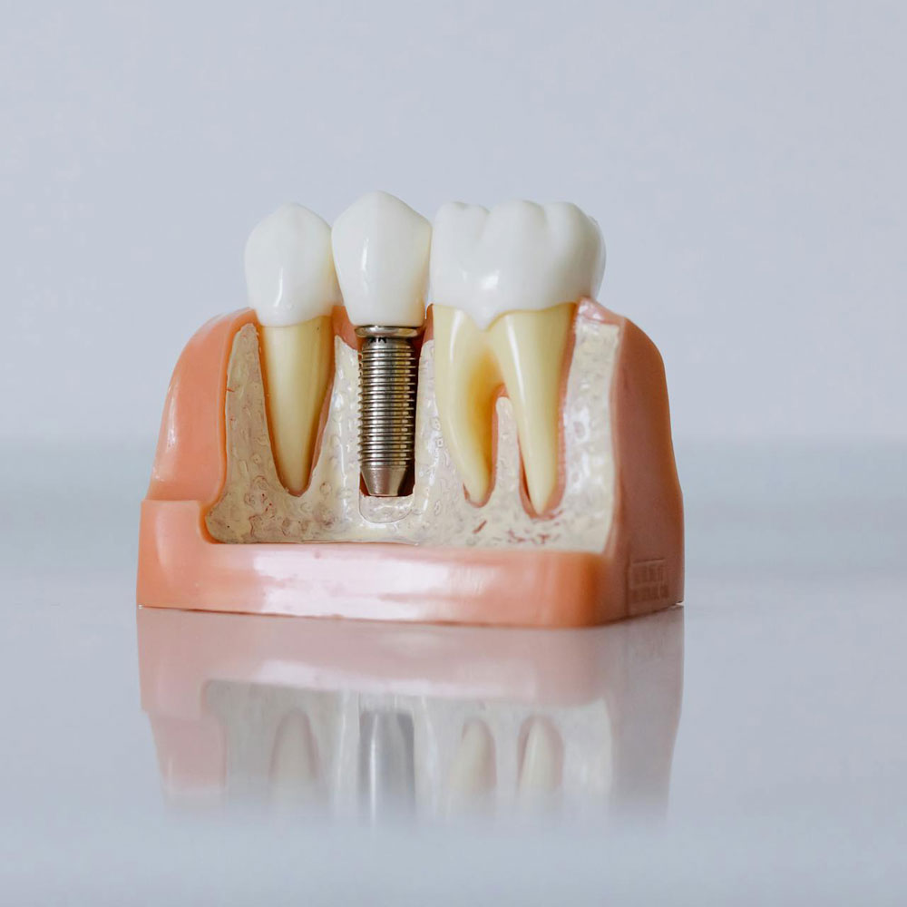 Dental Implants Placement and Restoration